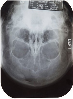 Рентгеновский снимок Монро, проданный за $26 500. Фото: elpais.com 